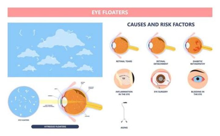 Are floaters caused by dry eyes?