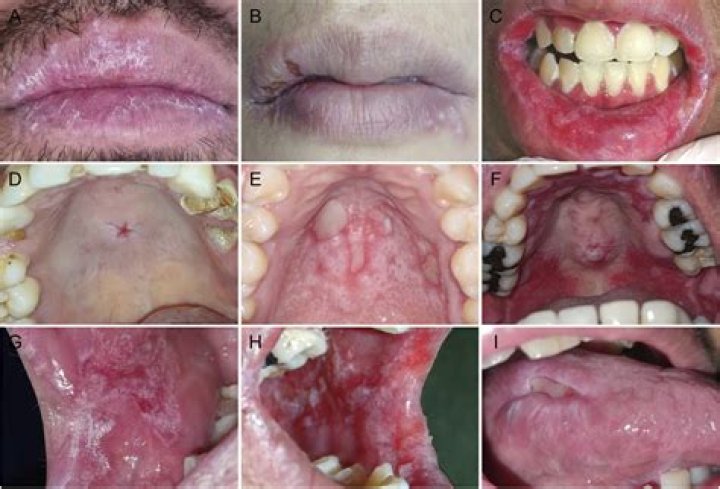 Are lupus and Epstein-Barr related?