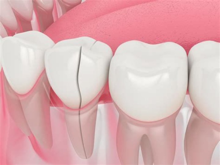 Can a tooth broken off at gum line be saved?