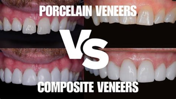 Can a veneer be glued back on?