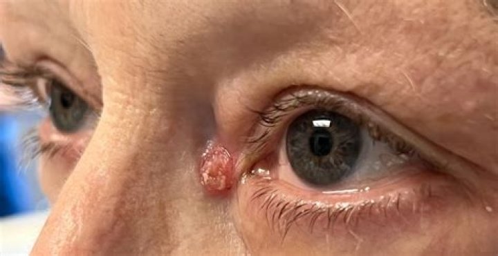 Can basal cell carcinoma affect eyesight?