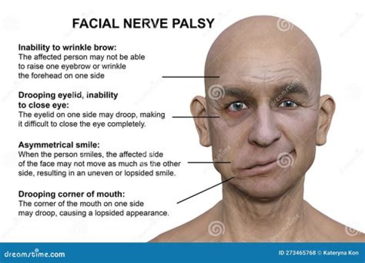 Can Bells Palsy be very mild?