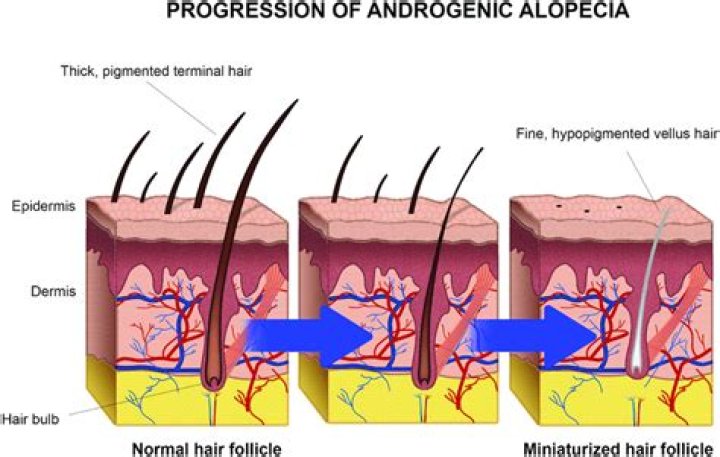 Can collagen cause alopecia?