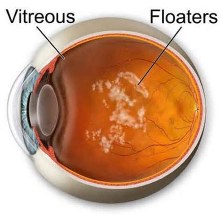 Can floaters cause you to go blind?