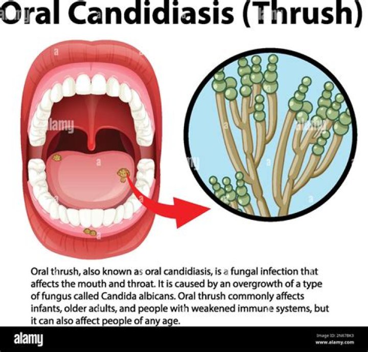 Can I kiss with oral thrush?