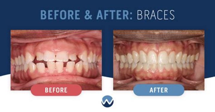 Can I remove my braces and get Invisalign?