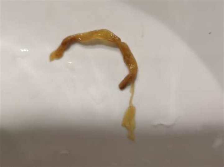 Can mucus in stool look like worms?