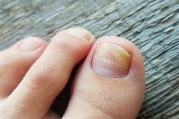 Can nail polish cause discoloration toenails?