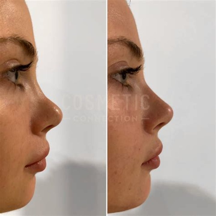 Can nose surgery go wrong?