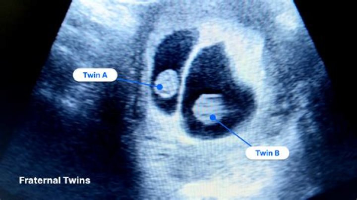 Can one twin consume the other in the womb?