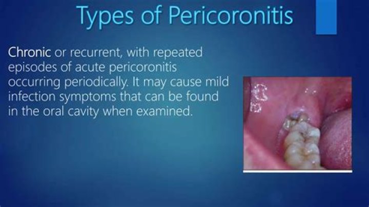 Can pericoronitis heal itself?