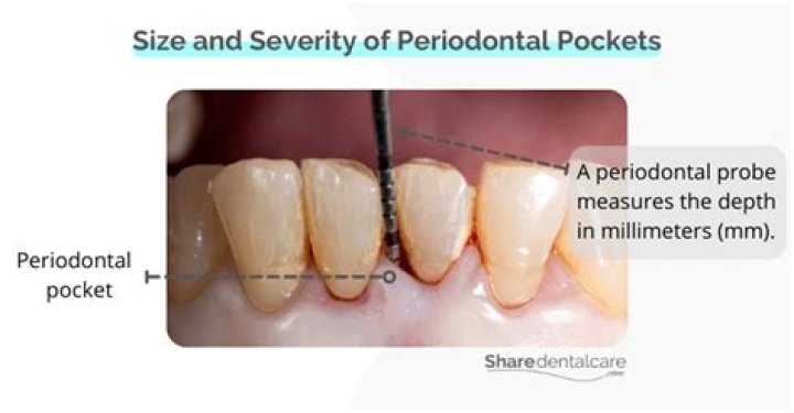 Can periodontal pockets shrink?