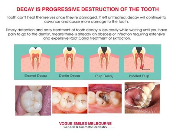 Can tooth decay be fixed?