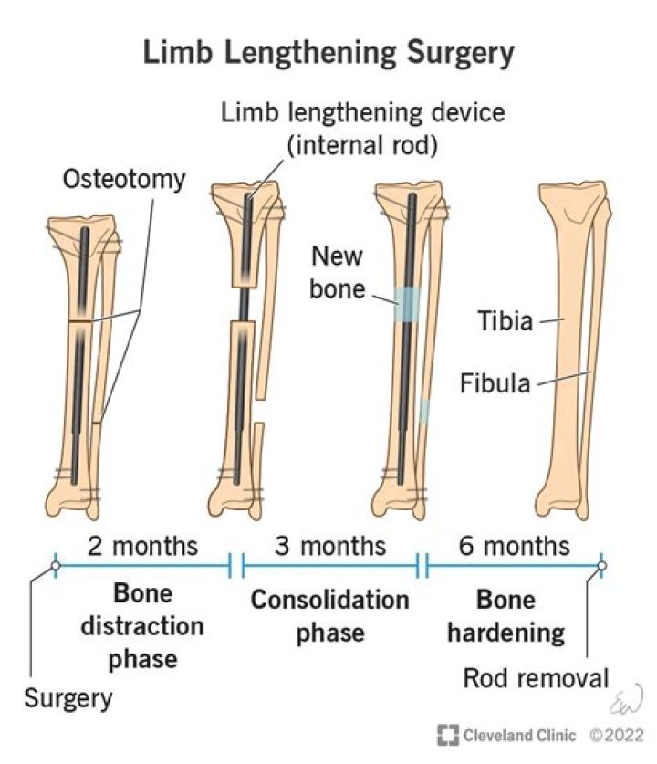 Can you drive after limb lengthening?