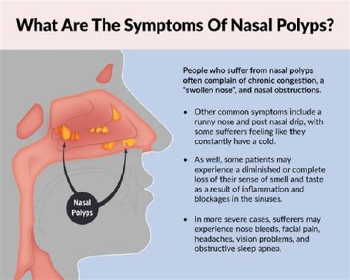 Can you feel nasal polyps with your finger?