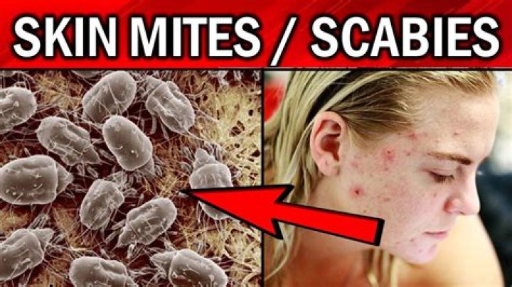 Can you get scabies in your hair?