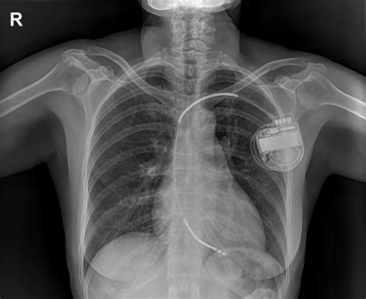 Can you have an MRI with a pacemaker?
