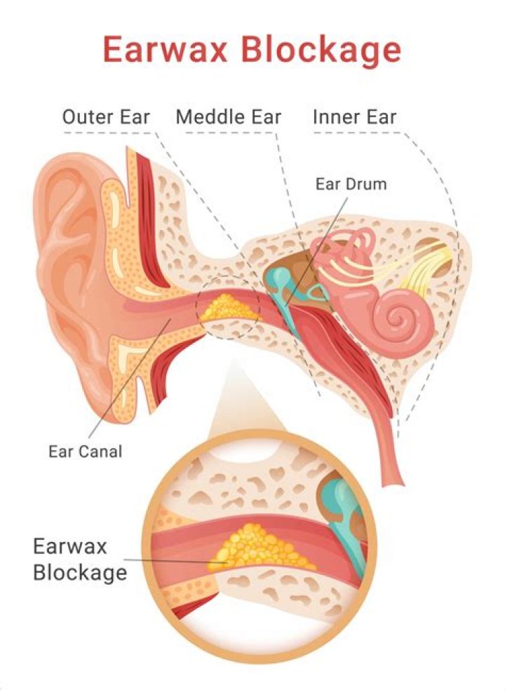 Can you hear earwax from your ear?