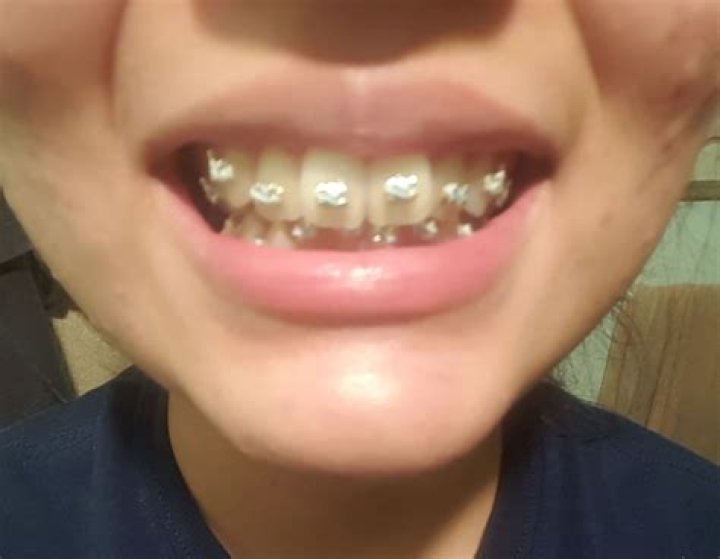 Do braces affect lips?