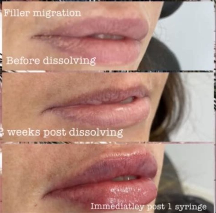 Do chin fillers move?