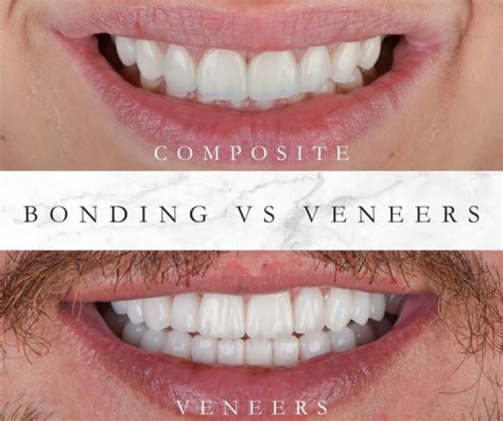 Do composite veneers fade?