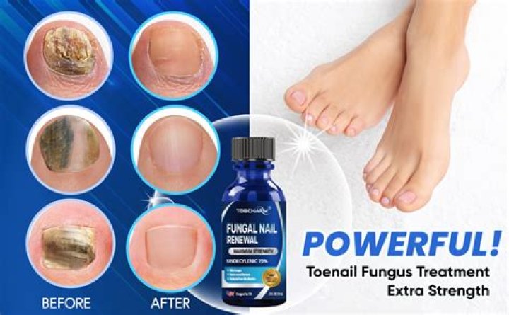 Do you have to throw away shoes if you have toenail fungus?
