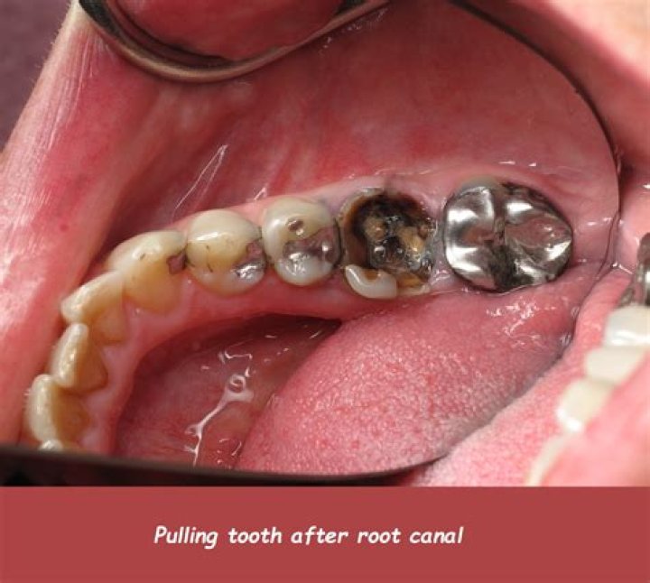 Does a gray tooth need to be pulled?