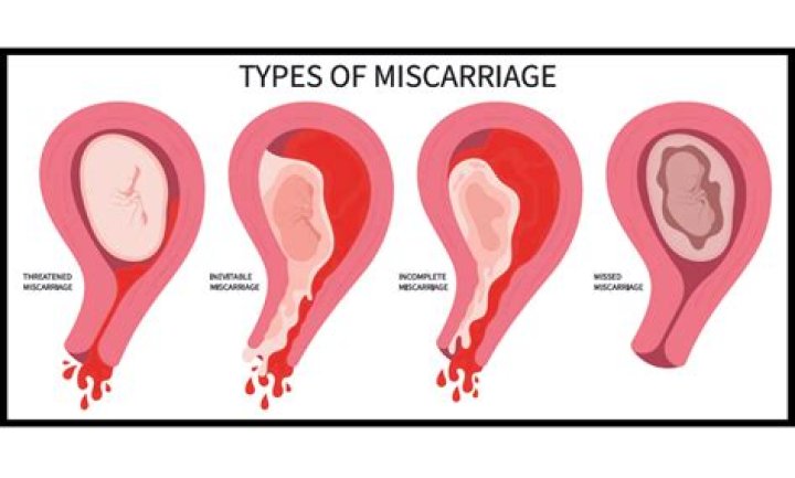Does being overweight cause miscarriage?