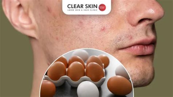 Does egg cause acne?