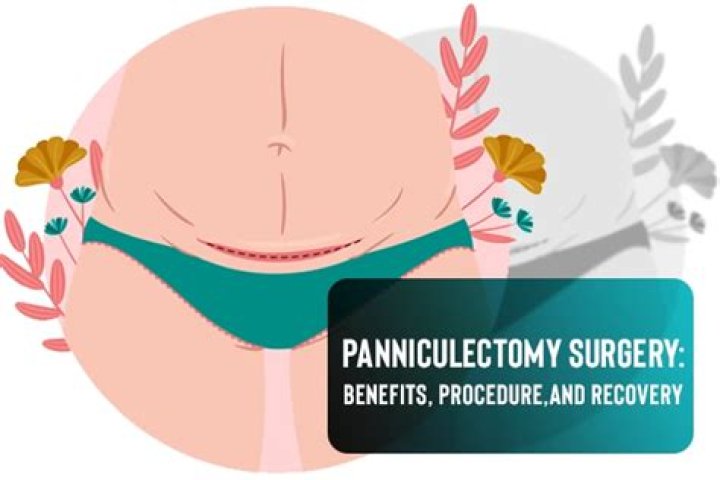 Does Florida blue cover Panniculectomy?