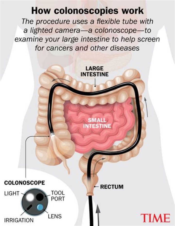 Does IBS show on colonoscopy?