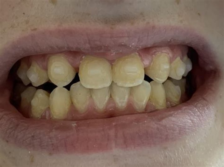 Does Invisalign turn teeth yellow?