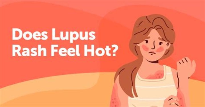 Does lupus make you feel hot?