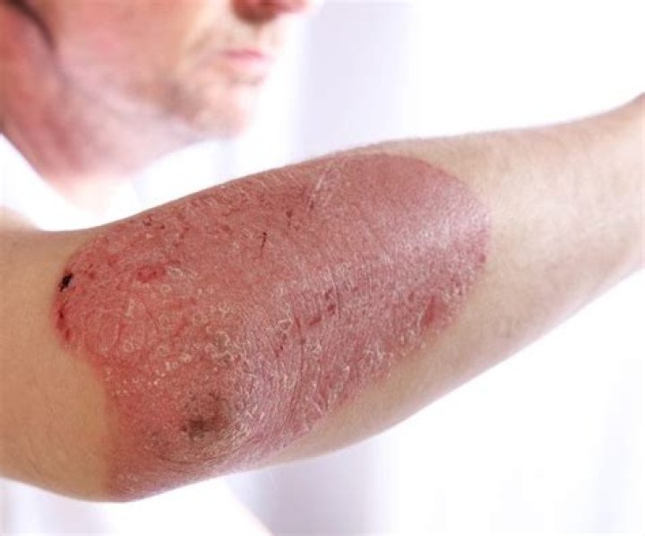 Does psoriasis go away on its own?