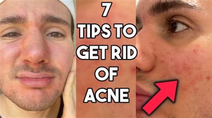 How can a 13 year old get rid of acne?