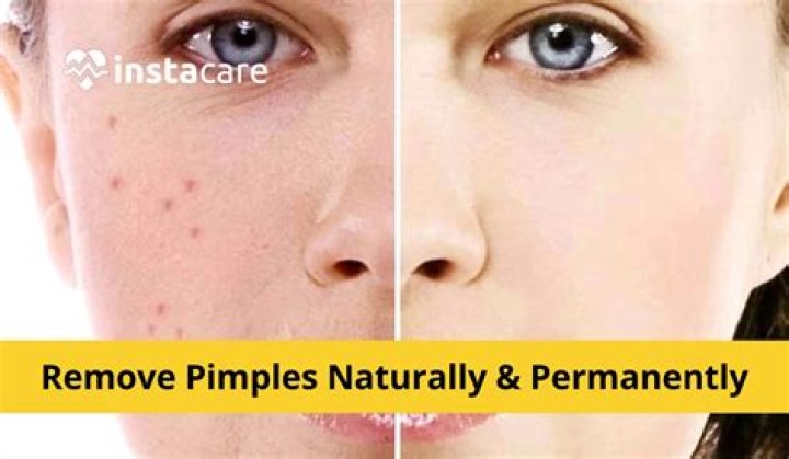 How can I get rid of pimples in 5 minutes naturally?