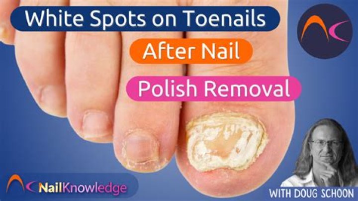 How do I get my toenails white again?