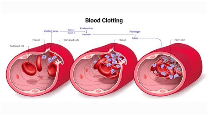 How do I get rid of a blood clot in my leg naturally?