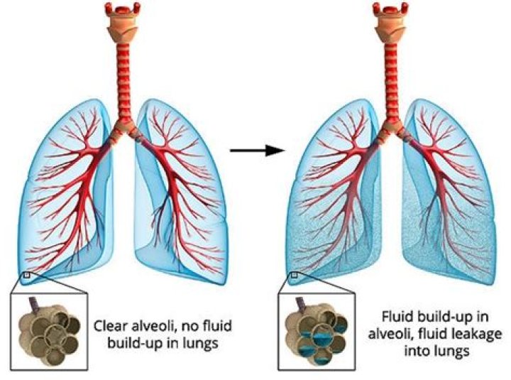 How do I know if I have fluid in my lungs?
