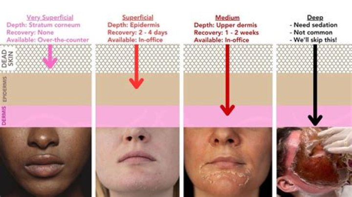 How do you do a peel out?