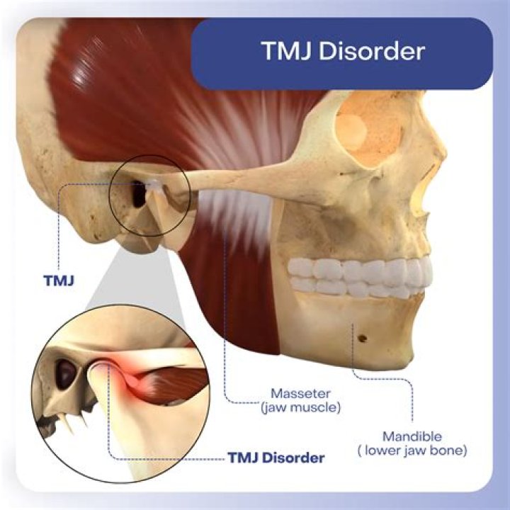 How do you eat after TMJ surgery?