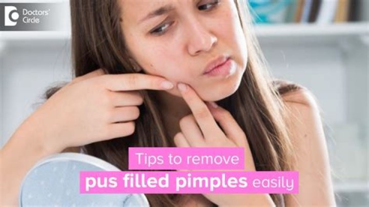 How do you get rid of pus-filled pimples?
