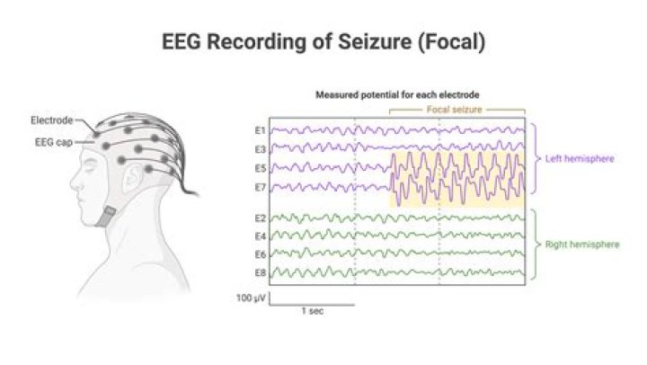 How do you stop continuous seizures?