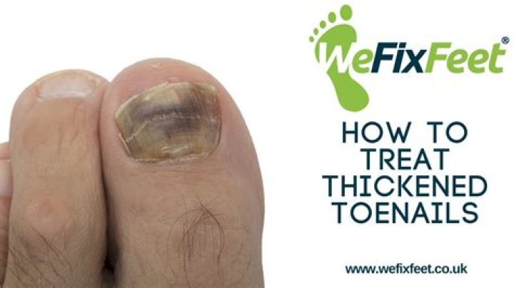 How do you treat thickened toenails?
