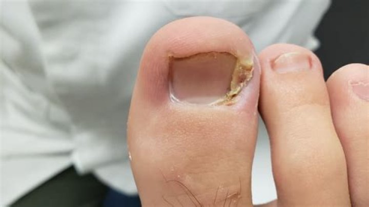 How do you treat white toenail fungus?
