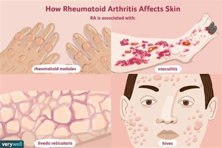 How does RA affect the skin?