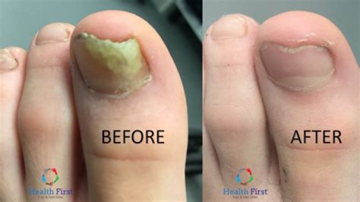 How fast does toenail fungus go away?