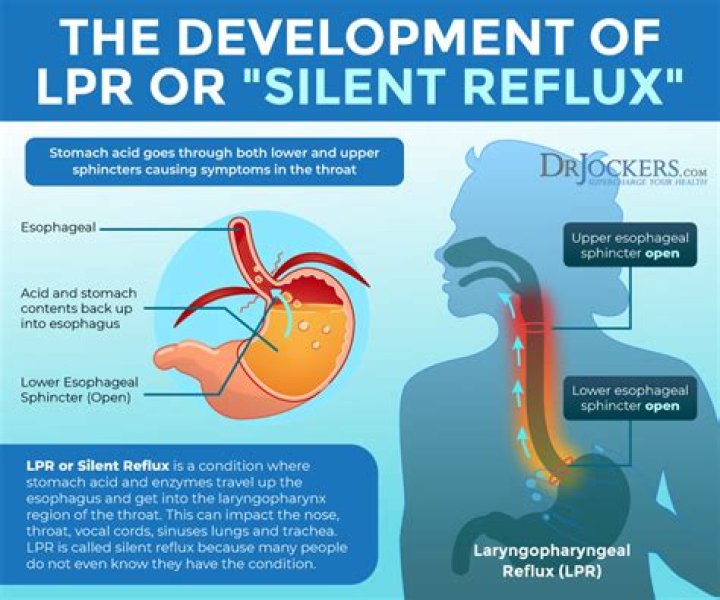 How I cured my silent reflux?