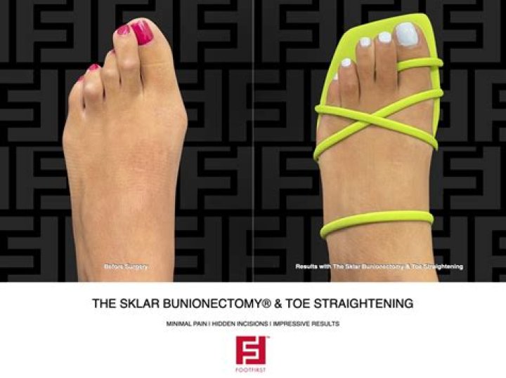 How is toe shortening done?