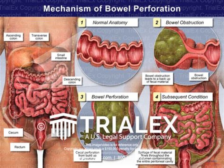 How long can you survive with a ruptured bowel?